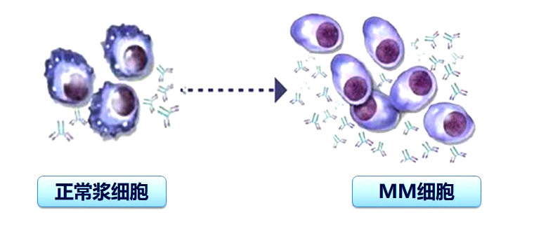 M蛋白上演消失的她?——淺談多發性骨髓瘤的診斷與療效評估 M蛋白上演消失的她?——淺談多發性骨髓瘤的診斷與療效評估
